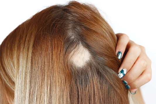 TrichoTestâ„¢: The Pharmacogenetic Approach to Personalize Alopecia Treatment