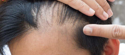 Procapil, Minoxidil, Finasteride, or Biotin? Understanding the Key Ingredients for Hair Loss Prevention