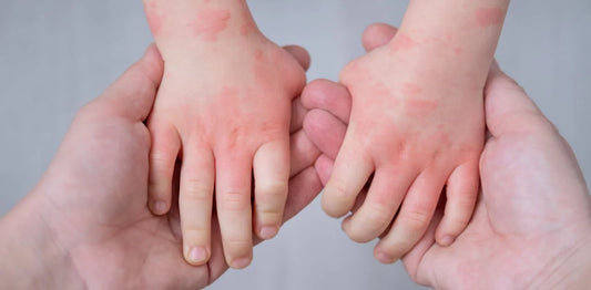 Understanding Eczema Genetic Predisposition: What You Need to Know