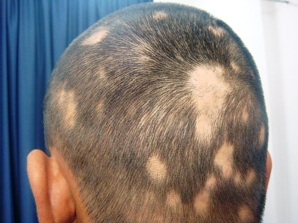 Hair Loss Treatment of Alopecia Areata with Tacrolimus