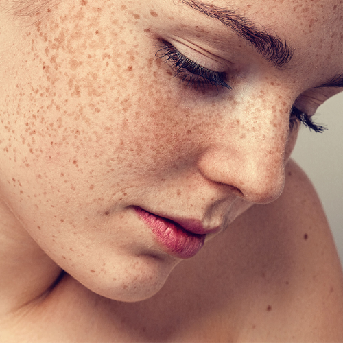 How to Get Rid of Dark Spots on the Face
