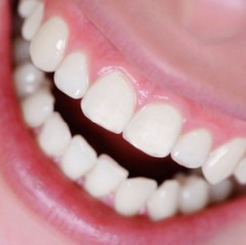 Receding Gums? You May Need Collagen
