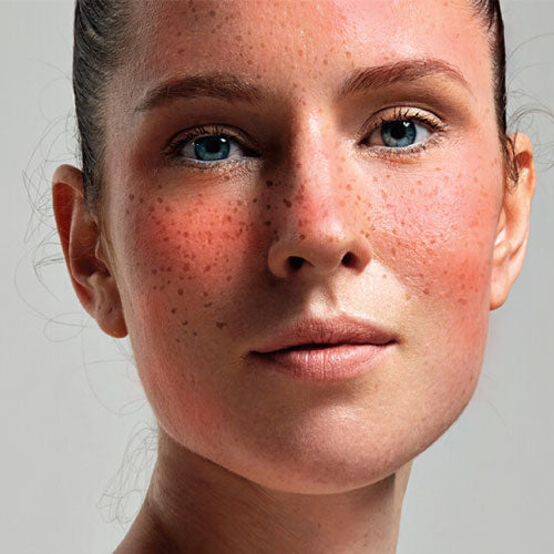 6 rosacea skin care tips