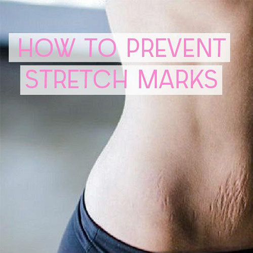How To Prevent Stretch Marks?