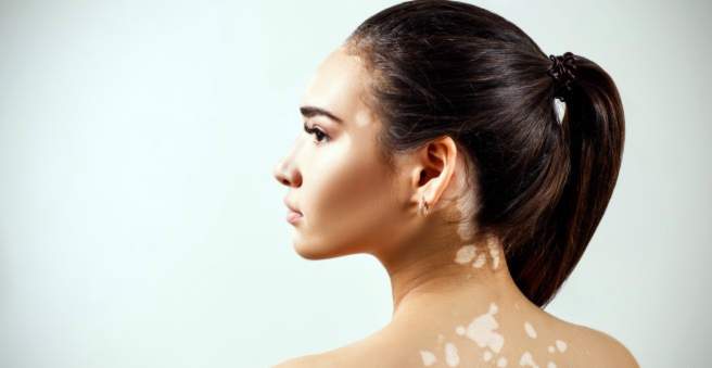 Collagen and Vitiligo: The Connection You Need to Know