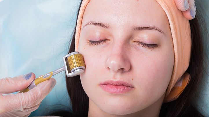 Discover the Benefits of Microneedling for Various Skin Conditions
